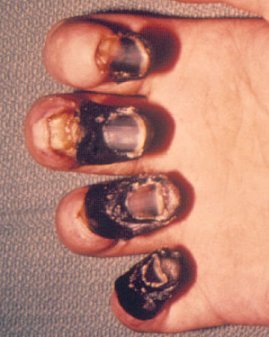 gangrene on foot
